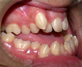 implantes dentales